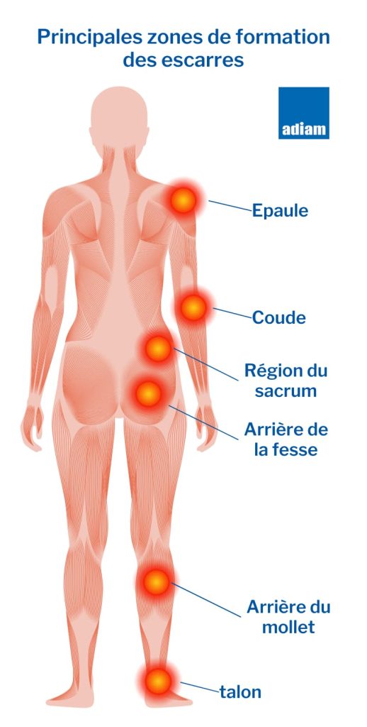 zone escarre corps