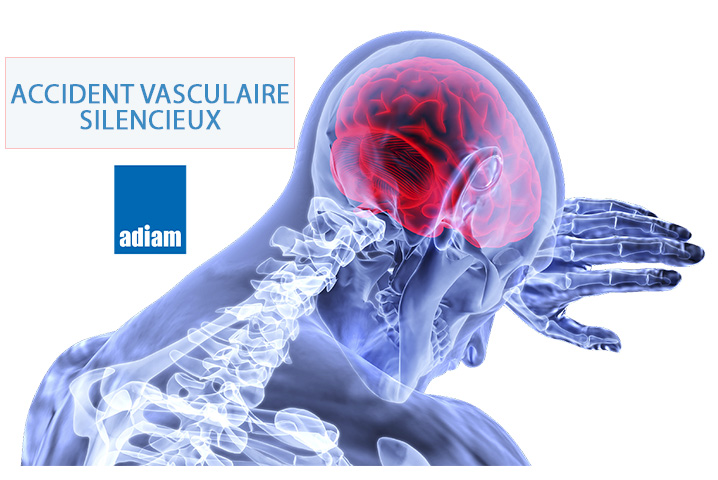 Accident vasculaire cérébral silencieux