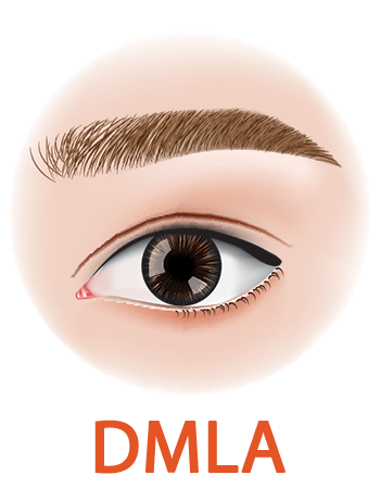 DMLA : maladie de l’œil