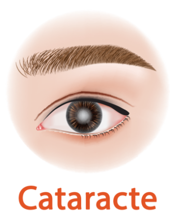 cataracte, maladie vision