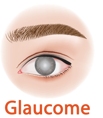 Glaucome Oeil