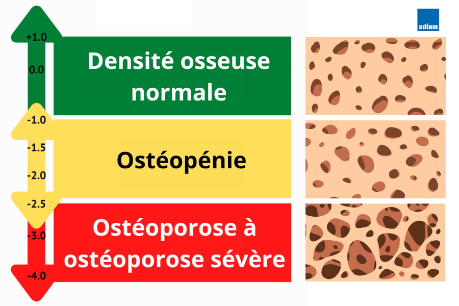 osteoporose osteodensitometrie