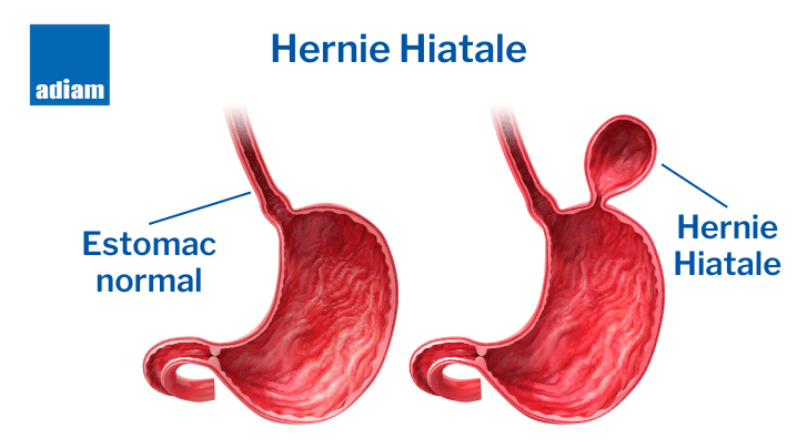 infigraphie hernie hiatale medicale