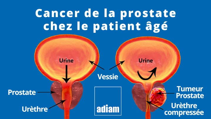 cancer prostate senior
