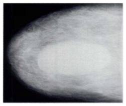 cancer sein inflammatoire mammographie