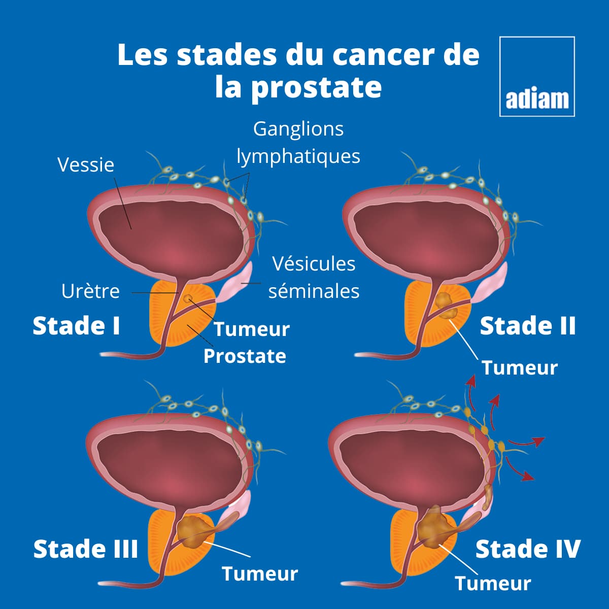 stade cancer prostate