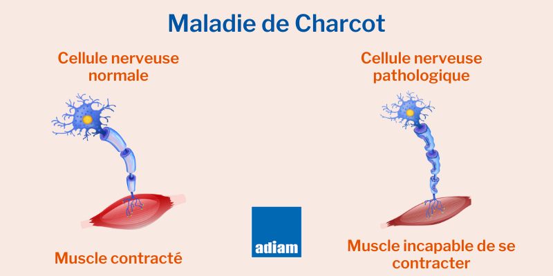 symptome maladie charcot