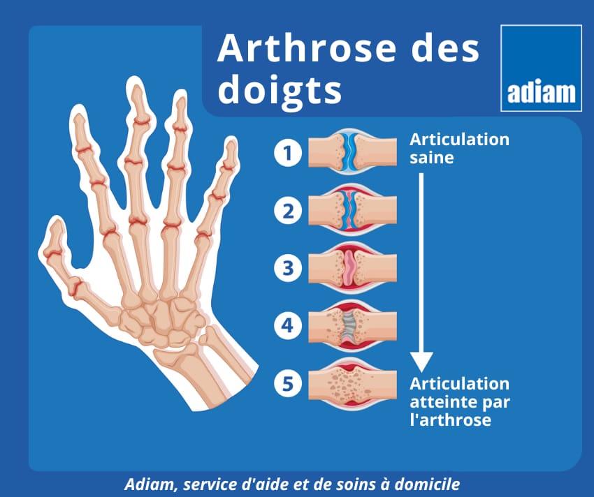 arthrose doigt main,