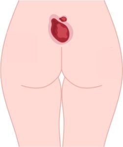 Escarre sacrum