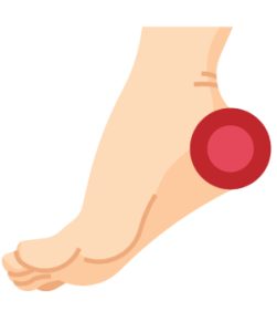 Escarre talon