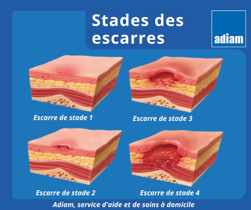 stade escarre stade 4